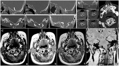 A Novel 12q13.2-q13.3 Microdeletion Syndrome With Combined Features of Diamond Blackfan Anemia, Pierre Robin Sequence and Klippel Feil Deformity